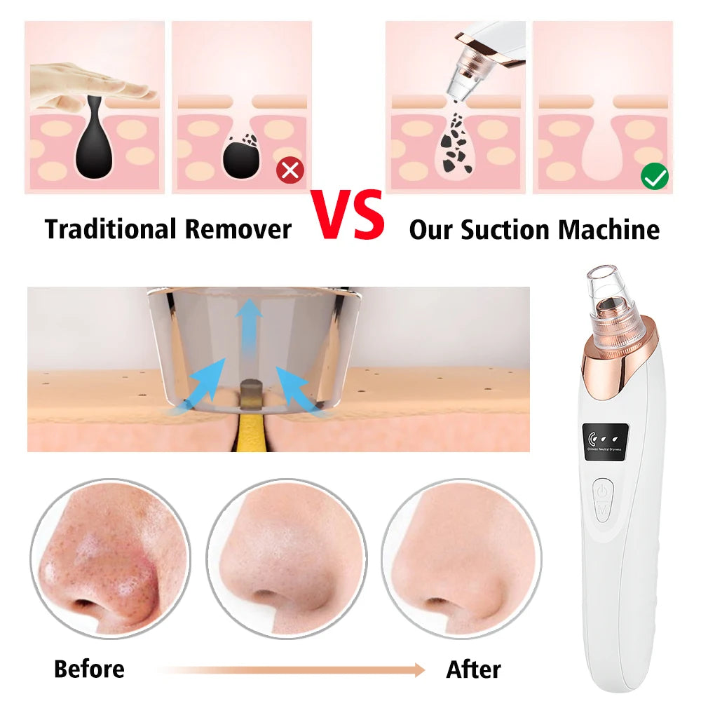 SwiftCart® Blackhead Remover Vacuum | USB Pore Cleaner - SwiftCart